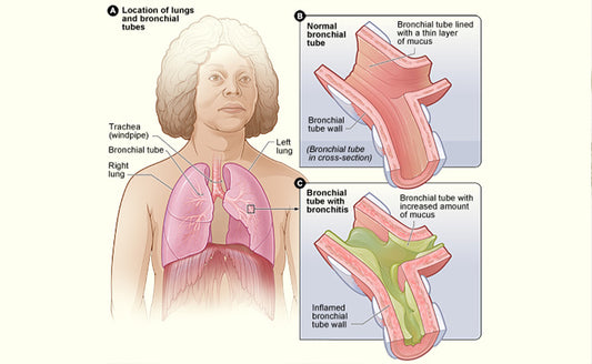 Bronchitis