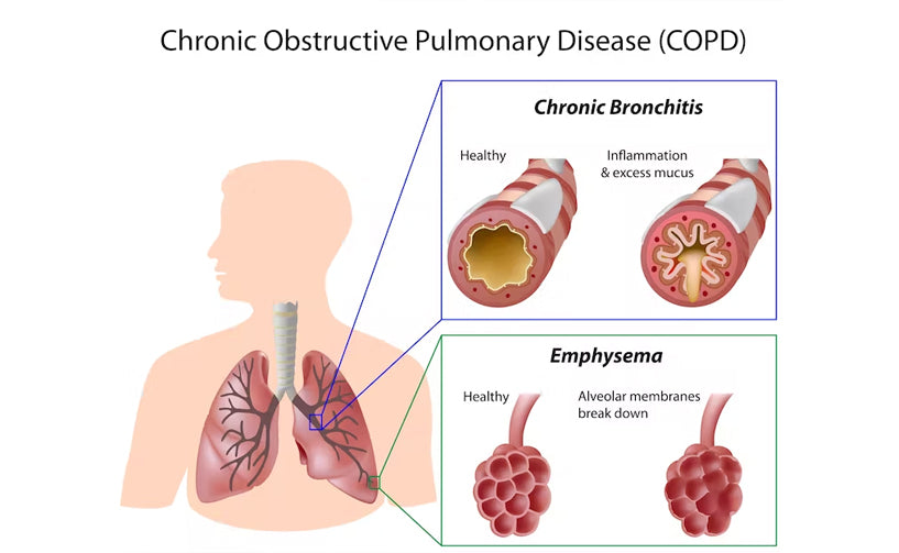 Chronic Obstructive Pulmonary Disease
