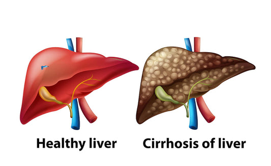 Cirrhosis