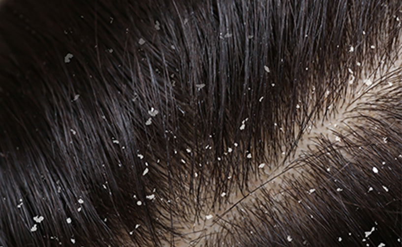 Dandruff