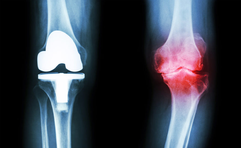 Osteoarthritis