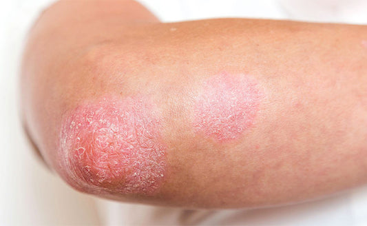 Psoriasis