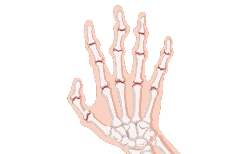 Rheumatoid Arthritis