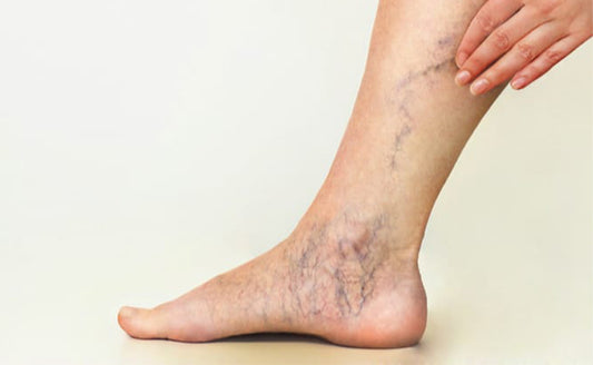 Varicose Veins