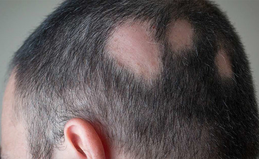 Alopecia