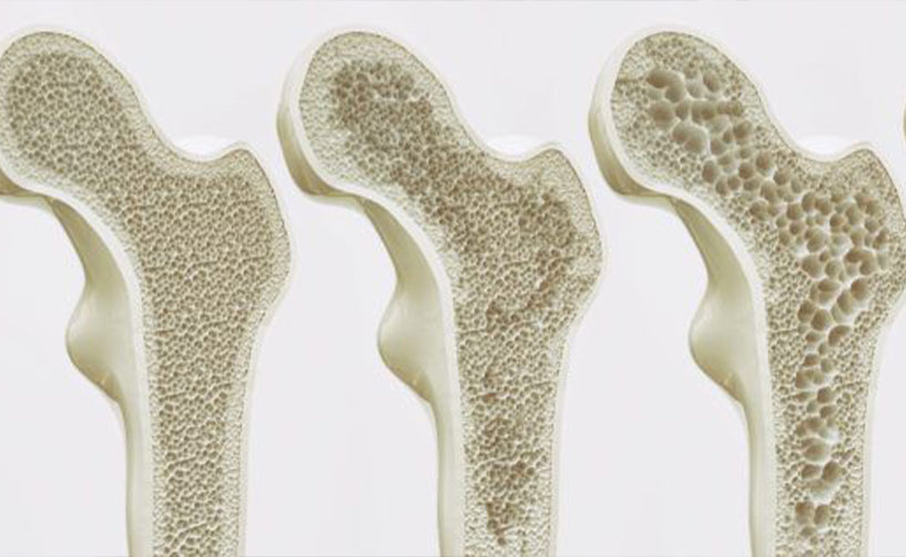 Bone Density