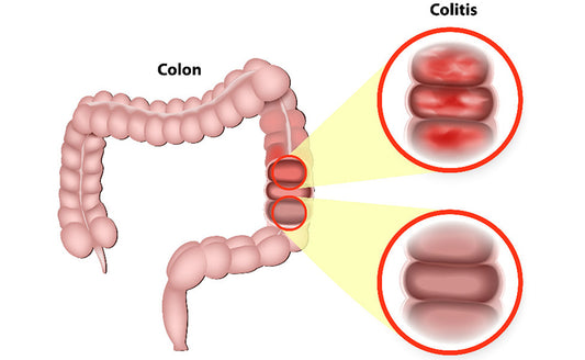 Ulcerative Colitis