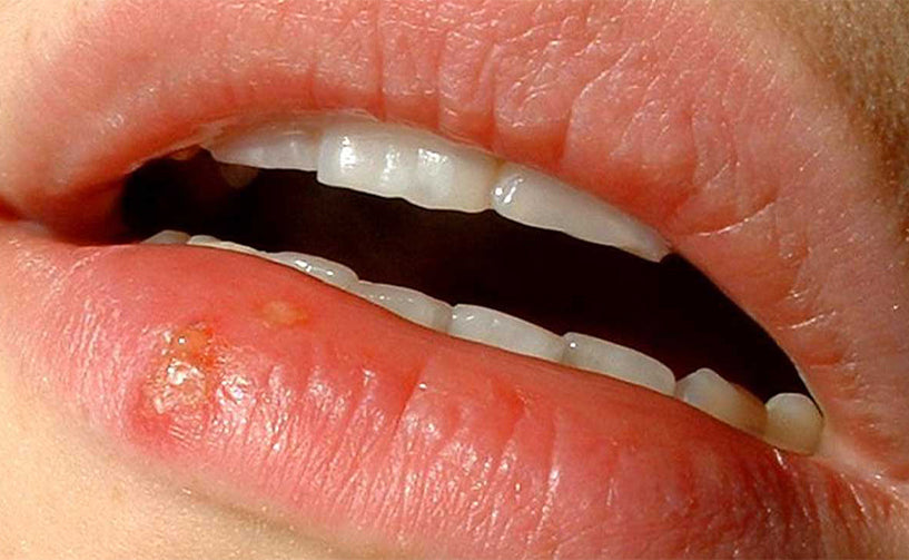 Canker Sore (Mouth Ulcer)